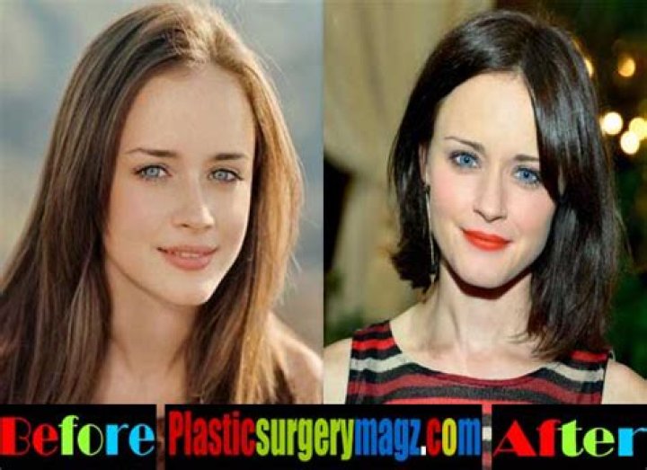 Alexis Bledel Plastic Surgery Before and After