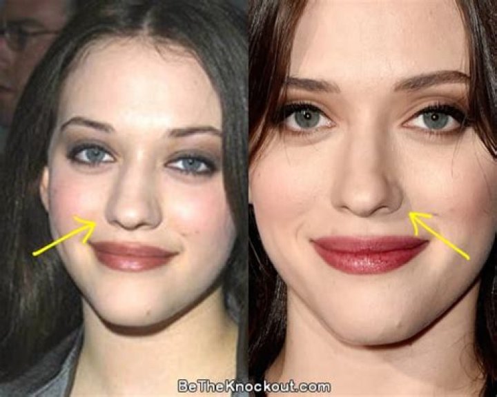 Kat Dennings Plastic Surgery Before and After