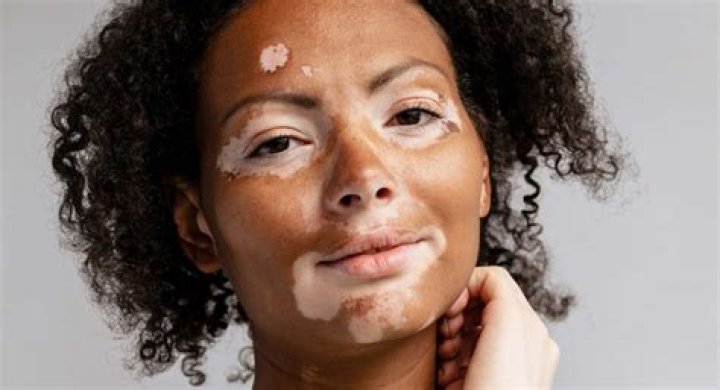 Maladie De Peau Vitiligo
