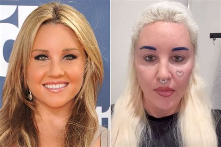Whitney Port Plastic Surgery Before and After